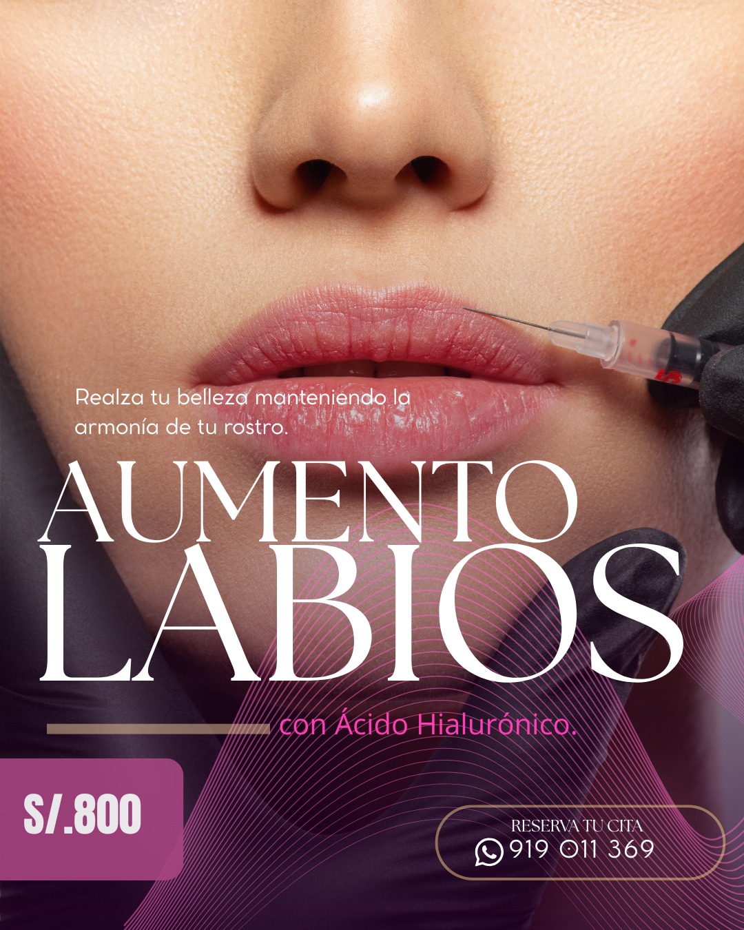 Aumento de labios con ácido hialurónico — S/ 800