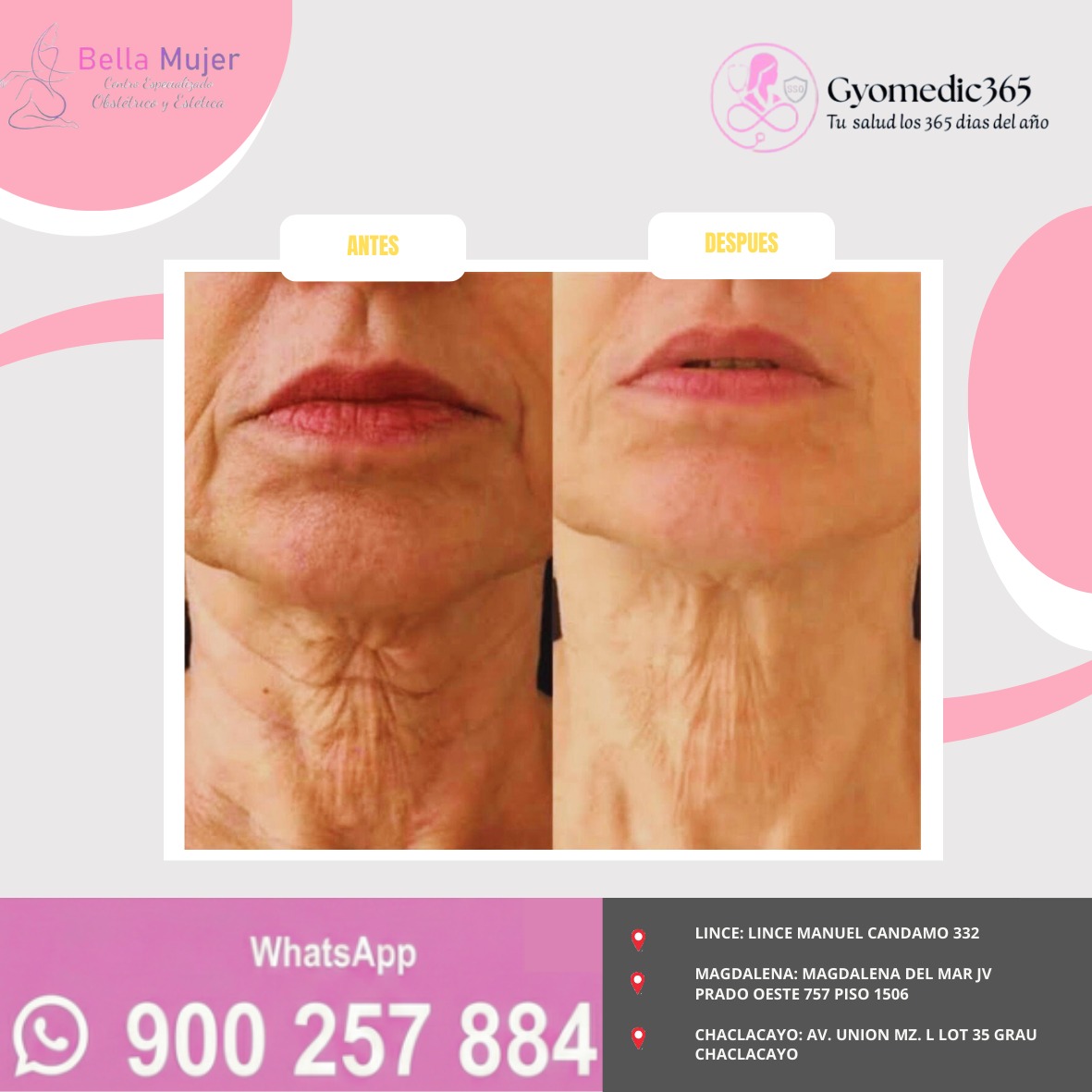 Antes y después — tratamiento de flacidez y arrugas en el cuello