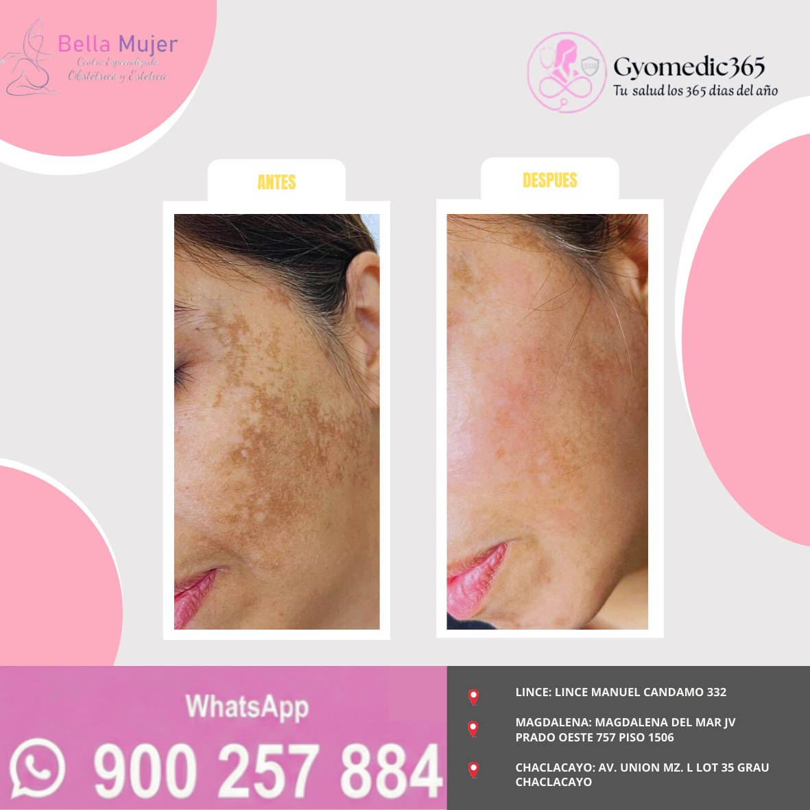 Antes y después — tratamiento de melasma y manchas faciales