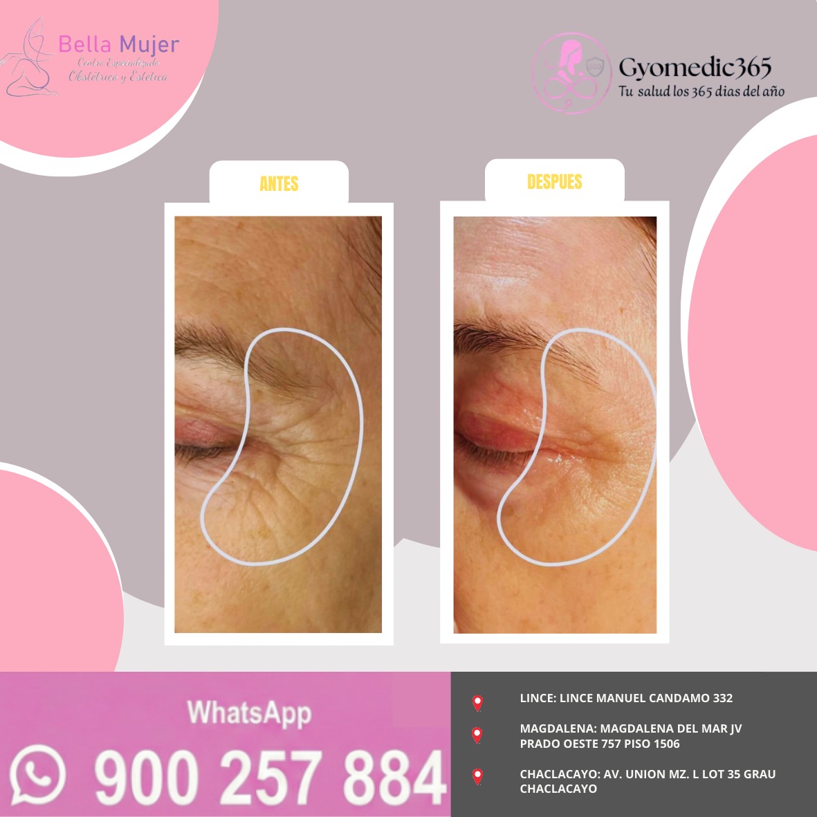 Antes y después — rejuvenecimiento del contorno de ojos